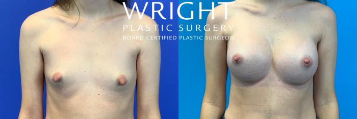 Before & After Breast Augmentation Case 140 Front View in Little Rock, Arkansas