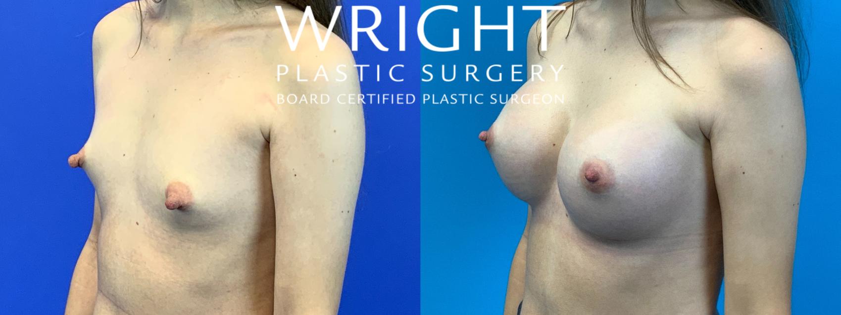 Before & After Breast Augmentation Case 140 Left Oblique View in Little Rock, Arkansas