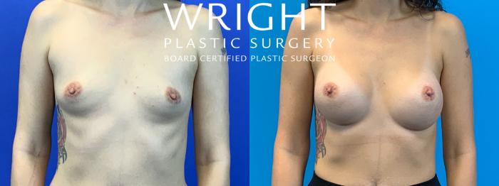 Before & After Breast Augmentation Case 141 Front View in Little Rock, Arkansas