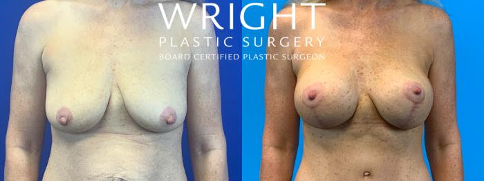 Before & After Breast Augmentation Case 143 Front View in Little Rock, Arkansas
