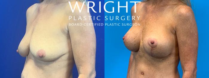 Before & After Breast Lift Case 143 Left Oblique View in Little Rock, Arkansas