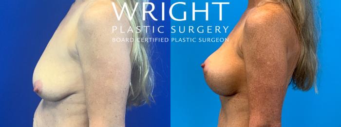 Before & After Breast Lift Case 143 Left Side View in Little Rock, Arkansas