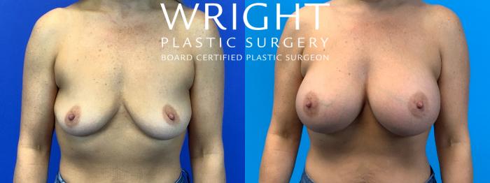 Before & After Breast Augmentation Case 146 Front View in Little Rock, Arkansas