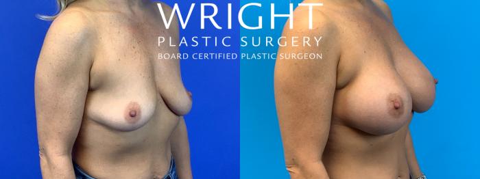Before & After Breast Augmentation Case 146 Right Oblique View in Little Rock, Arkansas