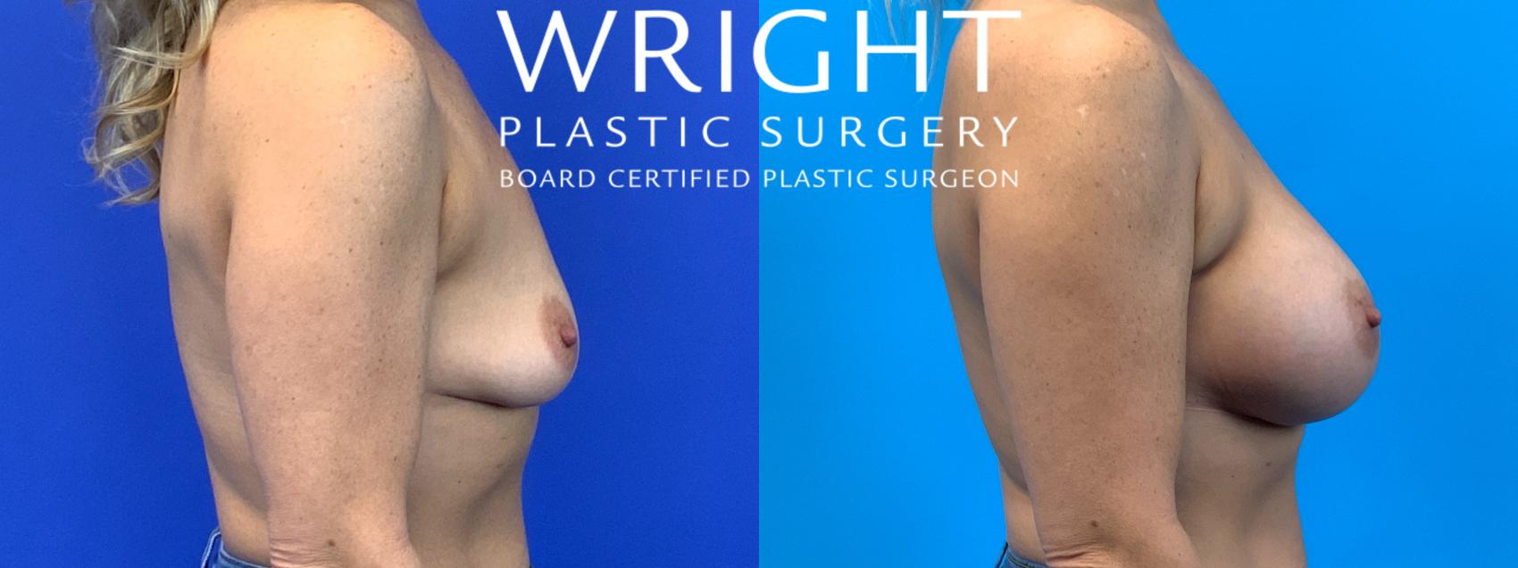 Before & After Breast Augmentation Case 146 Right Side View in Little Rock, Arkansas