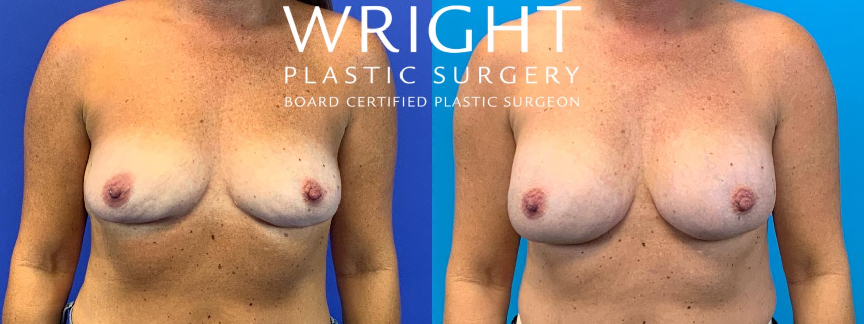 Before & After Breast Augmentation Case 153 Front View in Little Rock, Arkansas