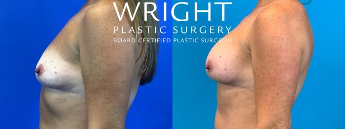 Before & After Breast Augmentation Case 153 Left Side View in Little Rock, Arkansas
