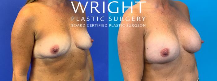 Before & After Breast Augmentation Case 153 Right Oblique View in Little Rock, Arkansas