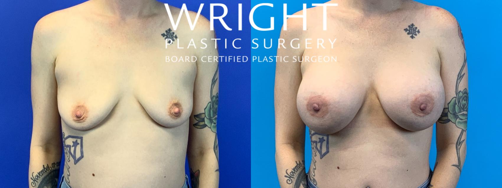 Before & After Breast Augmentation Case 160 Front View in Little Rock, Arkansas