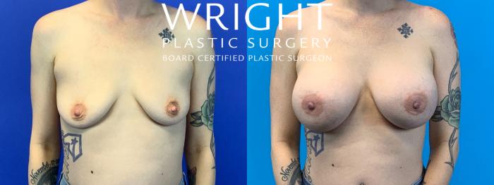 Before & After Breast Augmentation Case 160 Front View in Little Rock, Arkansas