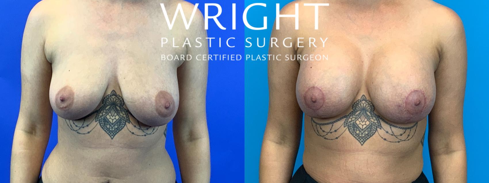 Before & After Breast Augmentation Case 177 Front View in Little Rock, Arkansas