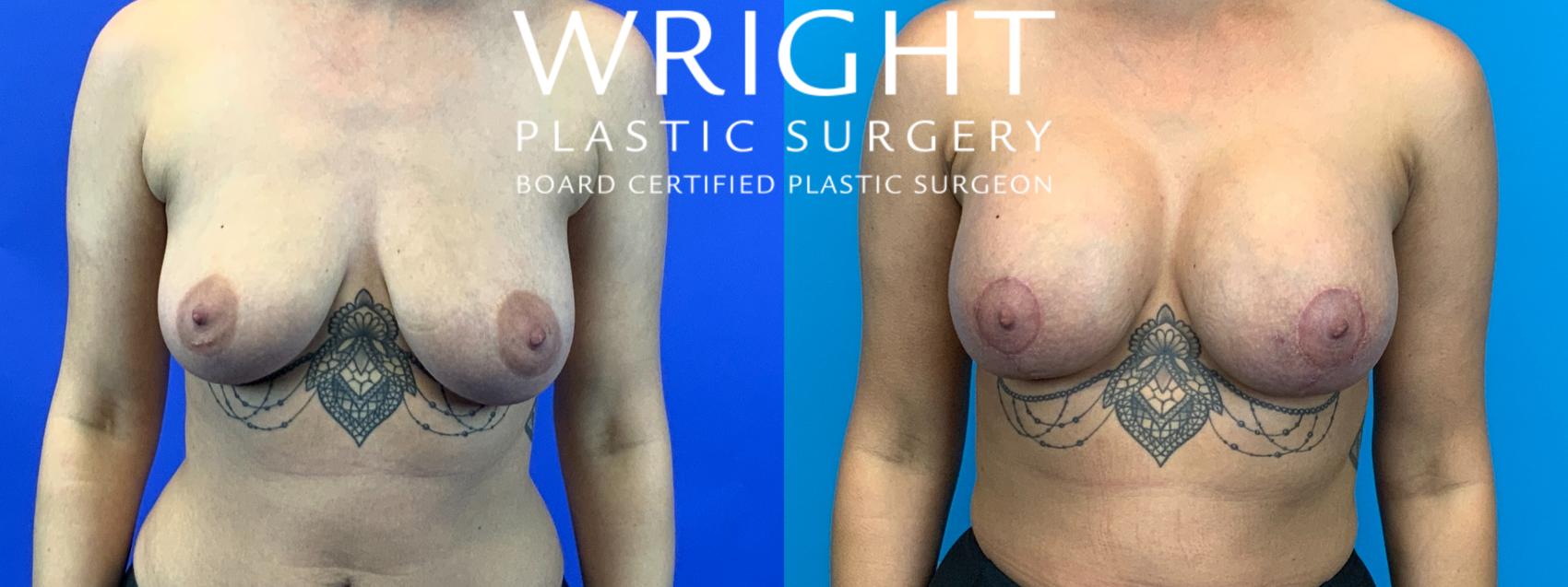 Before & After Breast Lift Case 177 Front View in Little Rock, Arkansas