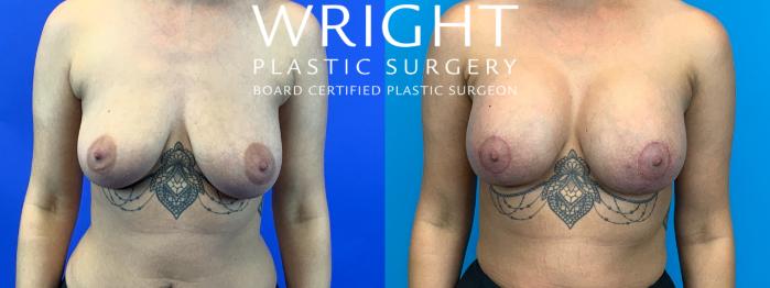 Before & After Breast Augmentation Case 177 Front View in Little Rock, Arkansas