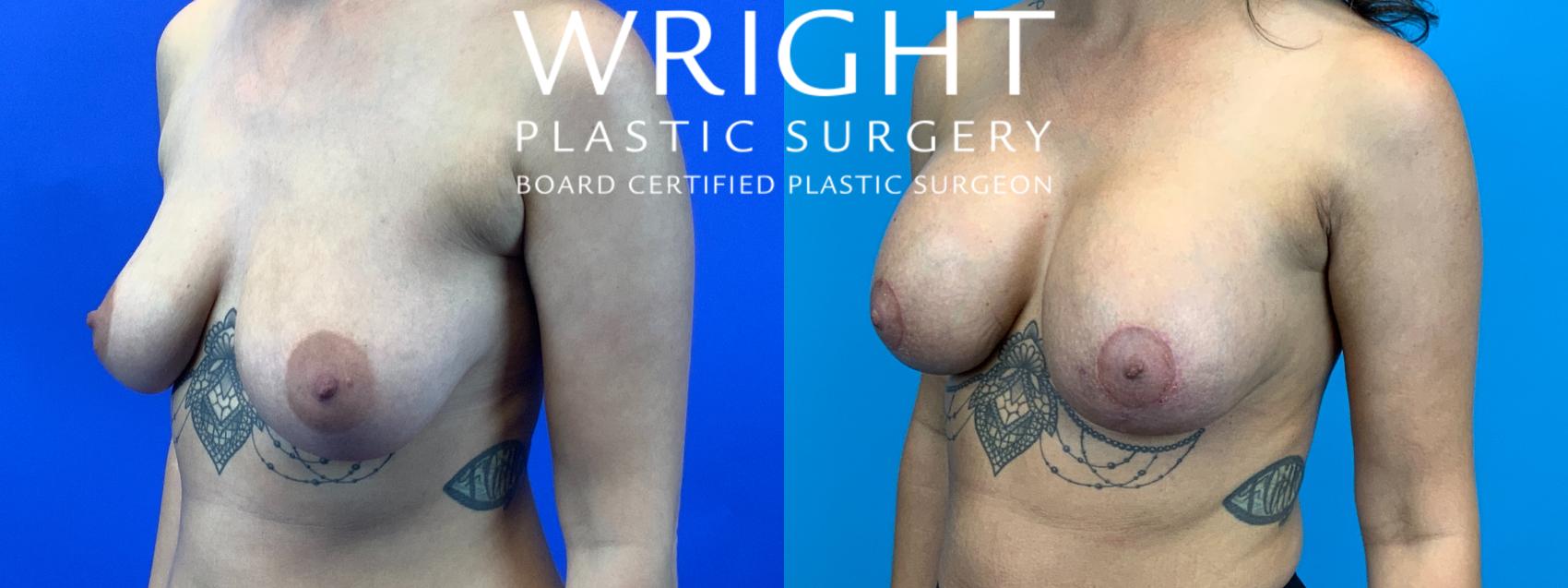 Before & After Breast Augmentation Case 177 Left Oblique View in Little Rock, Arkansas