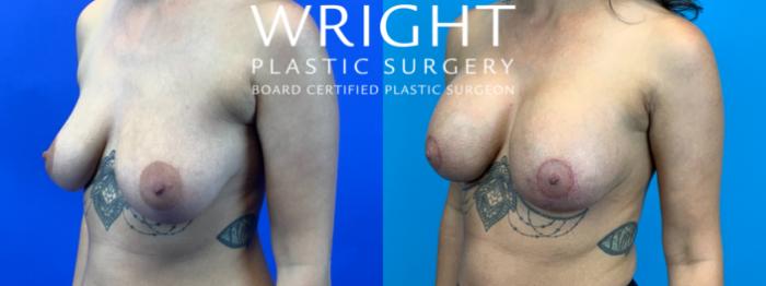 Before & After Breast Lift Case 177 Left Oblique View in Little Rock, Arkansas