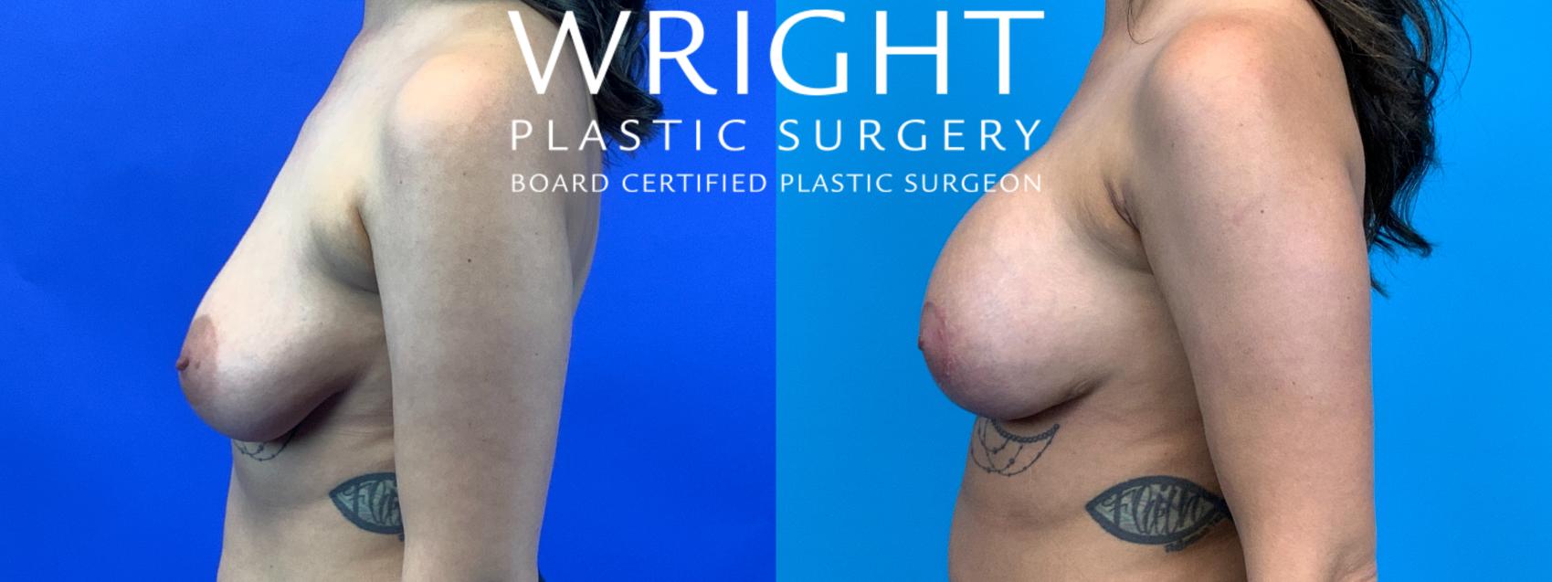 Before & After Breast Augmentation Case 177 Left Side View in Little Rock, Arkansas