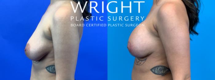 Before & After Breast Lift Case 177 Left Side View in Little Rock, Arkansas