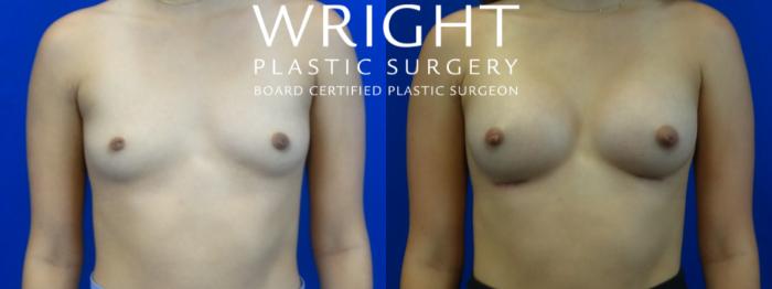 Before & After Breast Augmentation Case 18 Front View in Little Rock, Arkansas