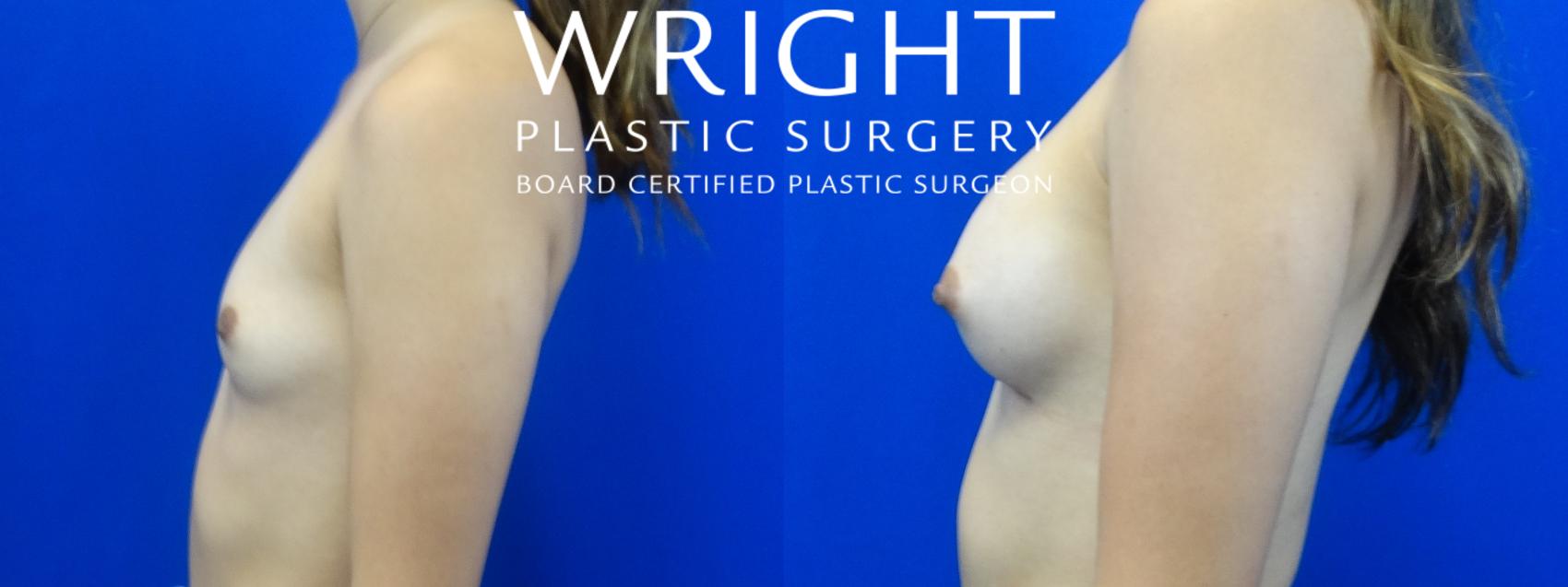 Before & After Breast Augmentation Case 18 Left Side View in Little Rock, Arkansas