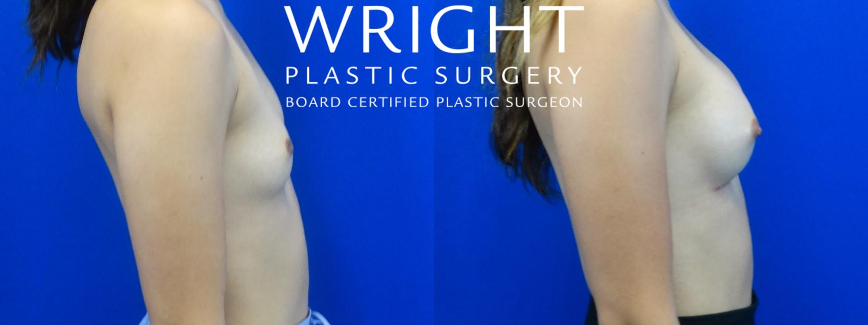 Before & After Breast Augmentation Case 18 Right Side View in Little Rock, Arkansas