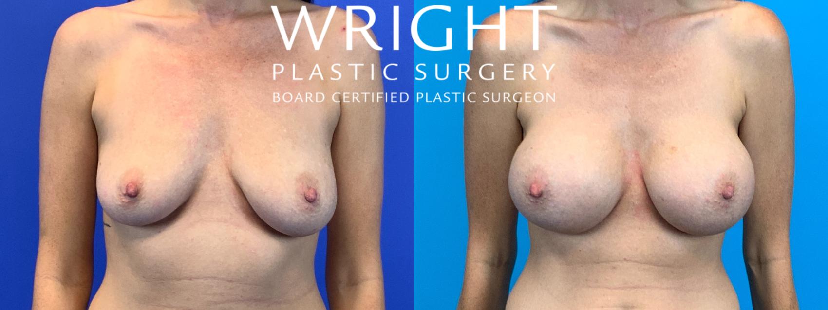 Before & After Breast Augmentation Case 187 Front View in Little Rock, Arkansas