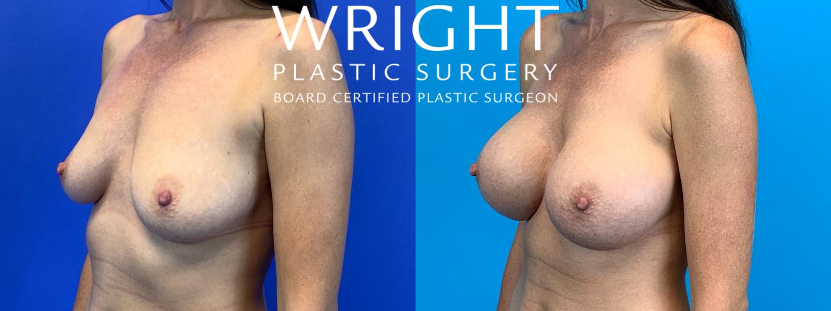 Before & After Breast Augmentation Case 187 Left Oblique View in Little Rock, Arkansas