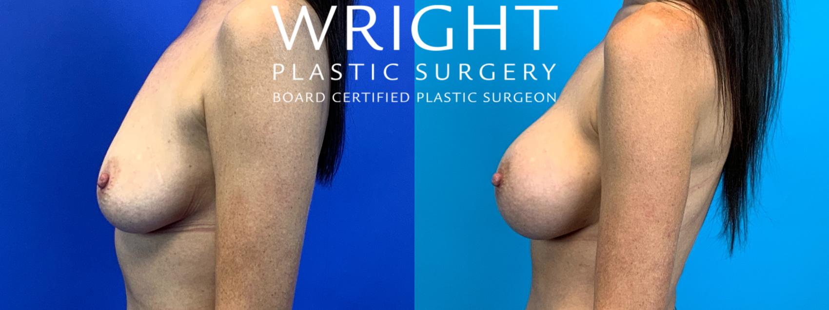 Before & After Breast Augmentation Case 187 Left Side View in Little Rock, Arkansas