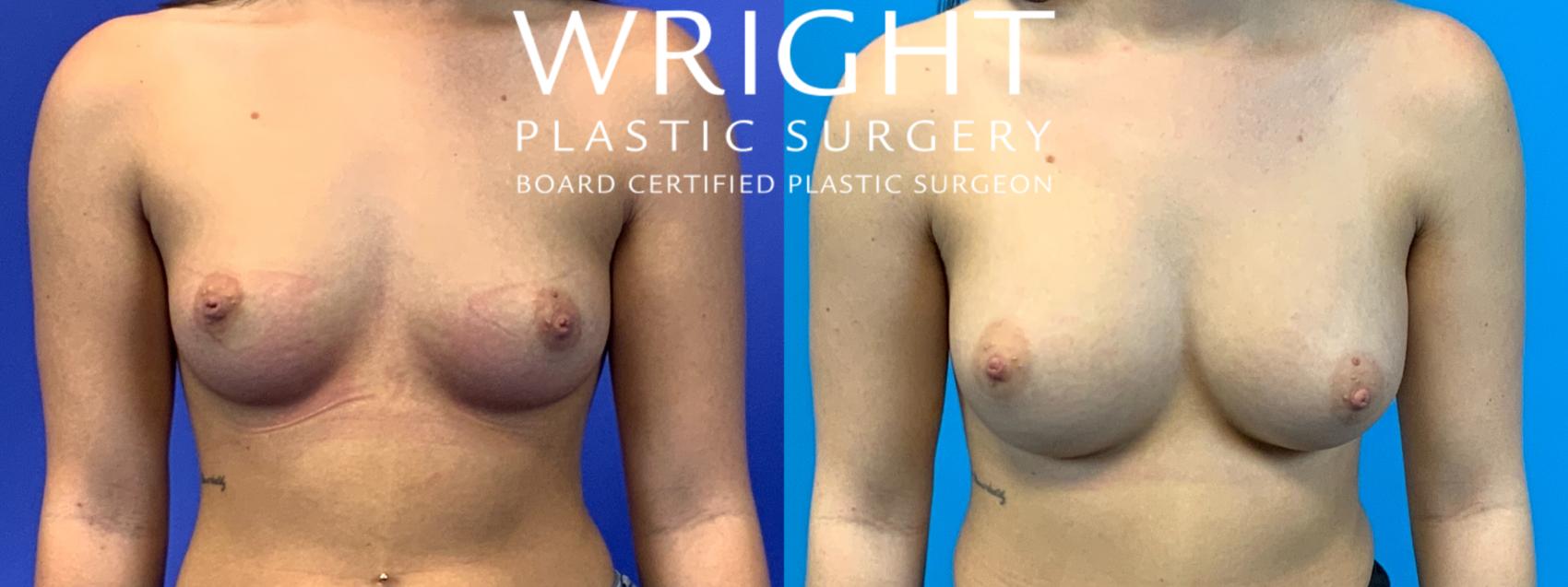 Before & After Breast Augmentation Case 193 Front View in Little Rock, Arkansas