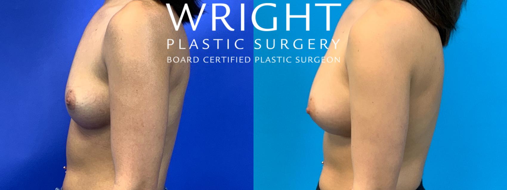 Before & After Breast Augmentation Case 193 Left Side View in Little Rock, Arkansas