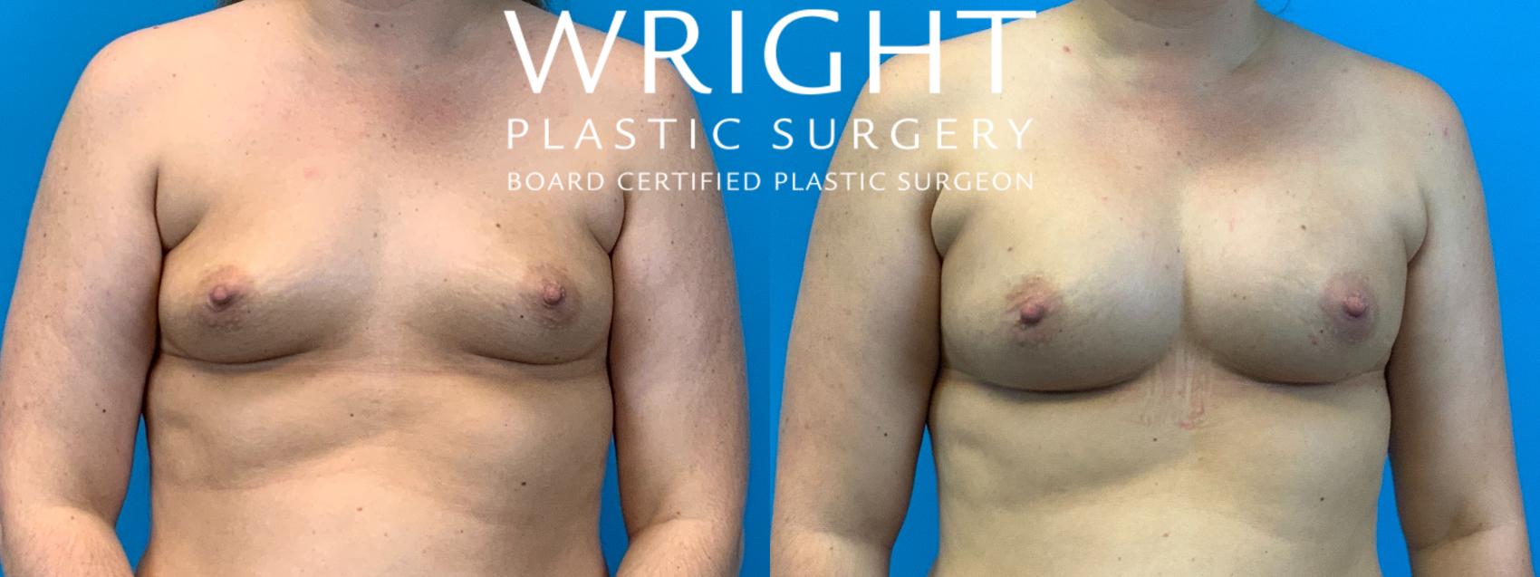 Before & After Breast Augmentation Case 208 Front View in Little Rock, Arkansas