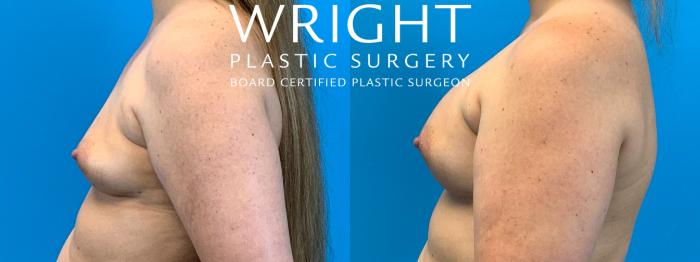 Before & After Breast Augmentation Case 208 Left Side View in Little Rock, Arkansas