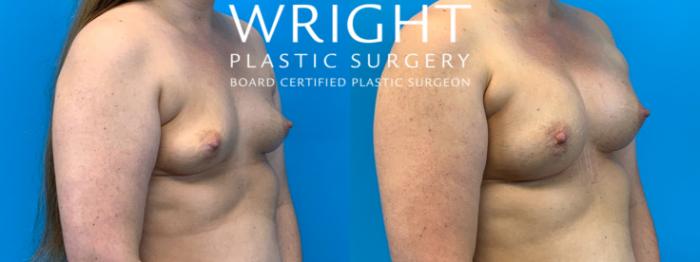 Before & After Breast Augmentation Case 208 Right Oblique View in Little Rock, Arkansas