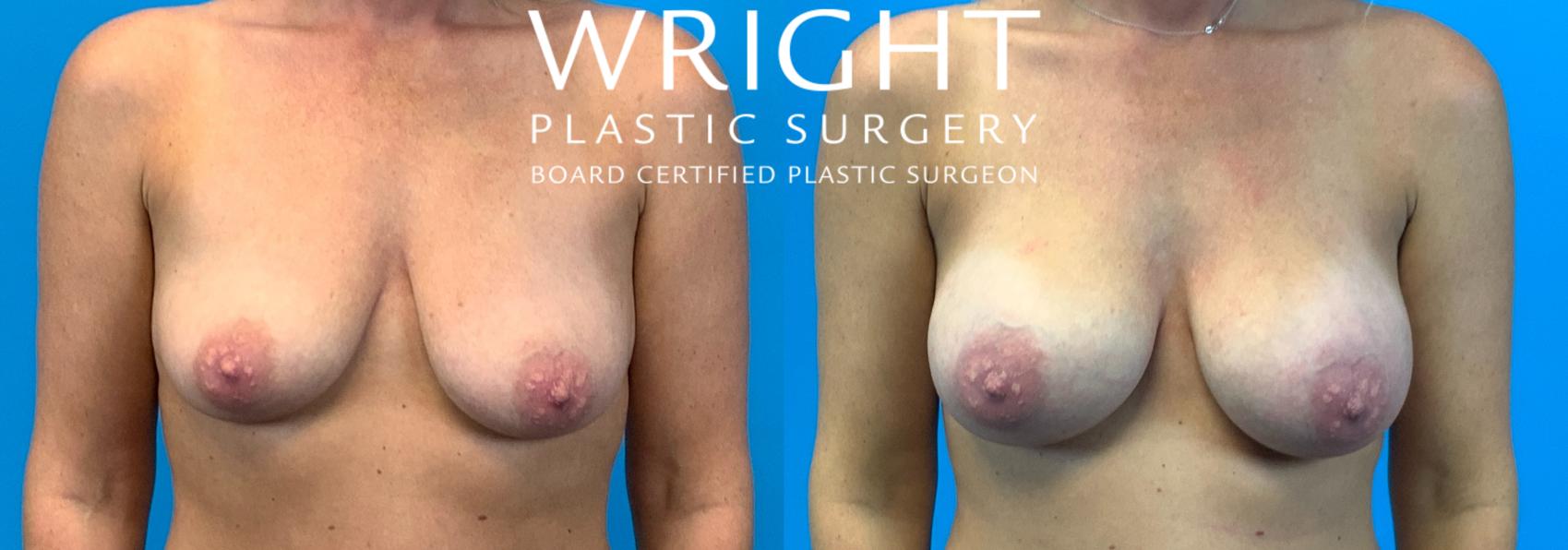 Before & After Breast Augmentation Case 210 Front View in Little Rock, Arkansas