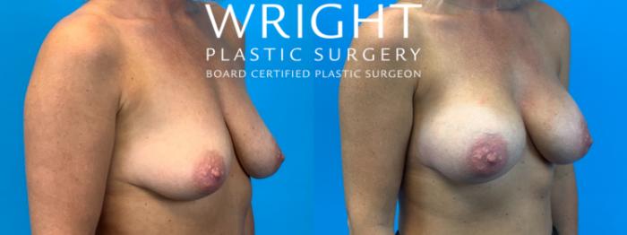 Before & After Breast Augmentation Case 210 Right Oblique View in Little Rock, Arkansas