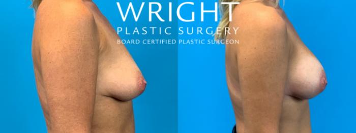 Before & After Breast Augmentation Case 210 Right Side View in Little Rock, Arkansas