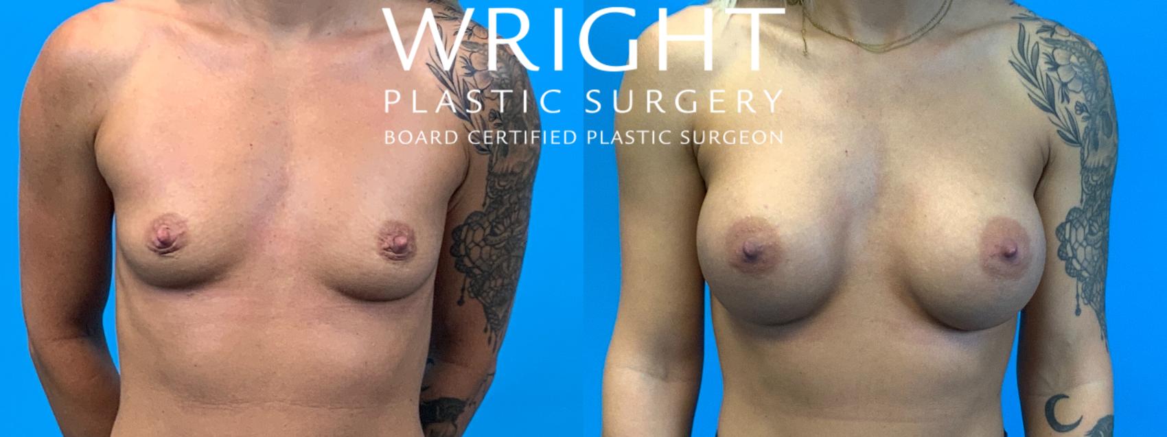 Before & After Breast Augmentation Case 221 Front View in Little Rock, Arkansas