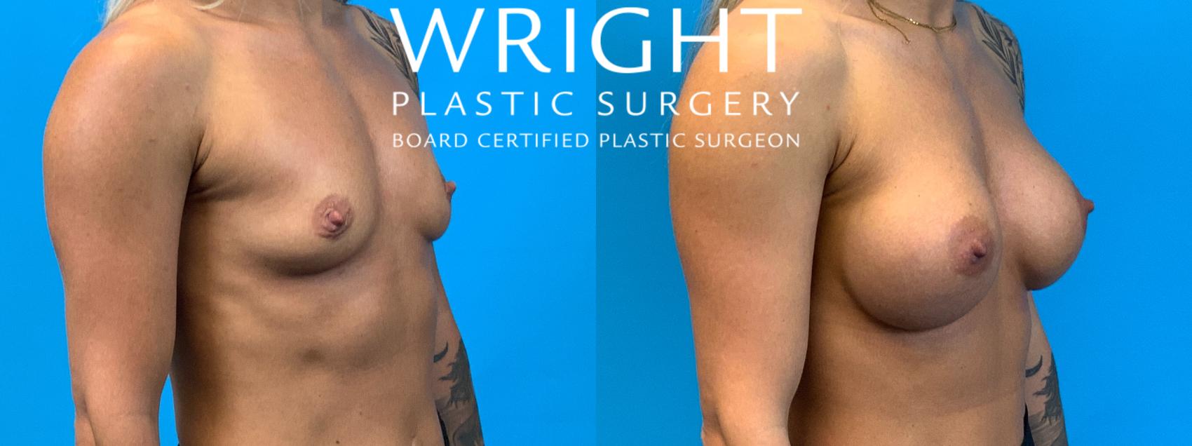 Before & After Breast Augmentation Case 221 Right Oblique View in Little Rock, Arkansas