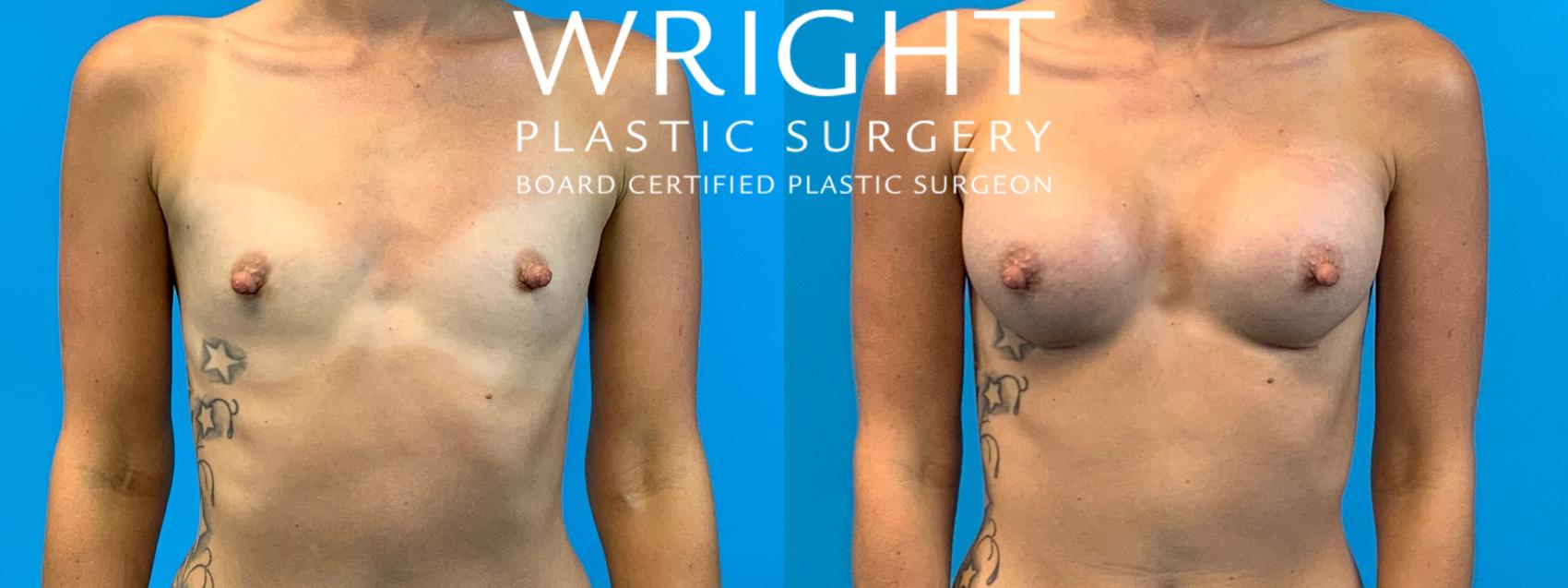 Before & After Breast Augmentation Case 227 Front View in Little Rock, Arkansas