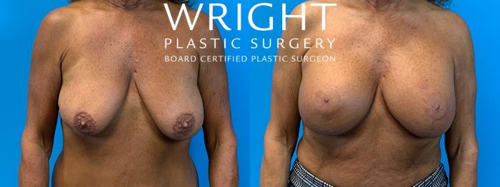 Before & After Breast Augmentation Case 228 Front View in Little Rock, Arkansas