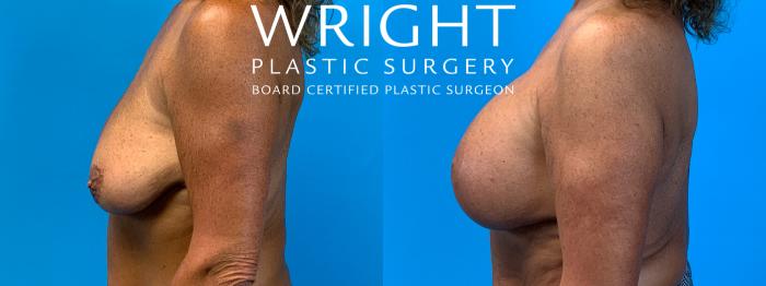 Before & After Breast Lift Case 228 Left Side View in Little Rock, Arkansas