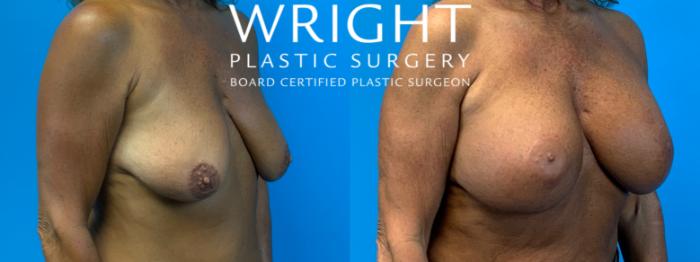 Before & After Breast Lift Case 228 Right Oblique View in Little Rock, Arkansas