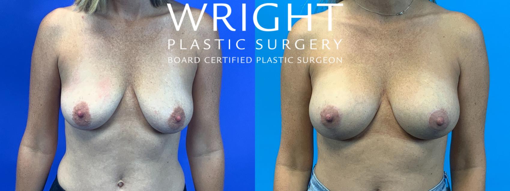 Before & After Breast Augmentation Case 229 Front View in Little Rock, Arkansas
