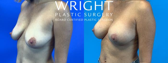 Before & After Breast Lift Case 229 Left Oblique View in Little Rock, Arkansas