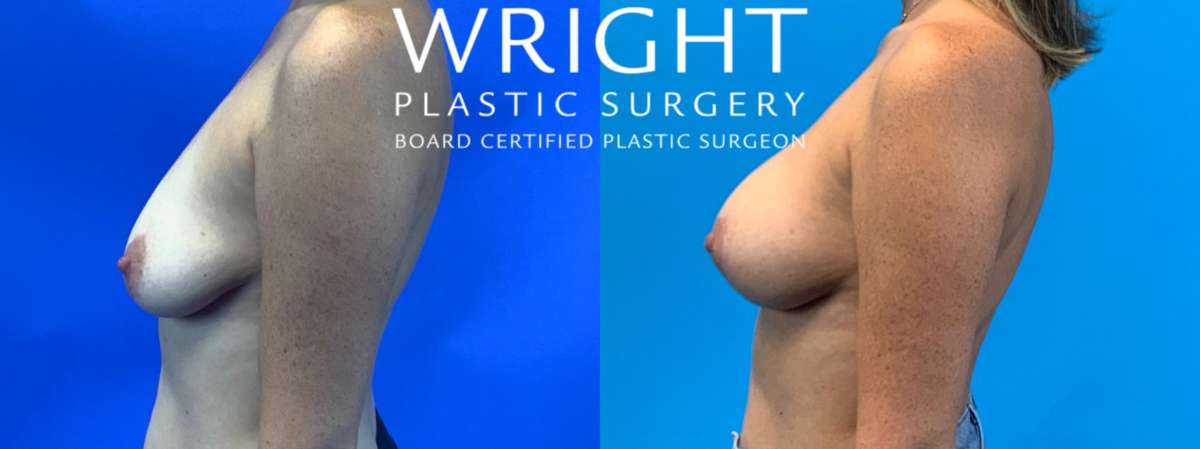 Before & After Breast Augmentation Case 229 Left Side View in Little Rock, Arkansas