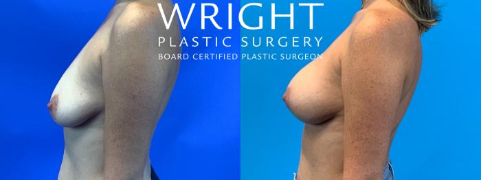 Before & After Breast Lift Case 229 Left Side View in Little Rock, Arkansas