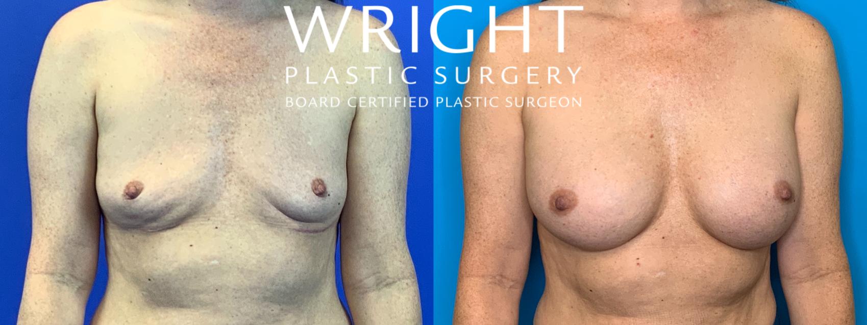 Before & After Breast Augmentation Case 234 Front View in Little Rock, Arkansas