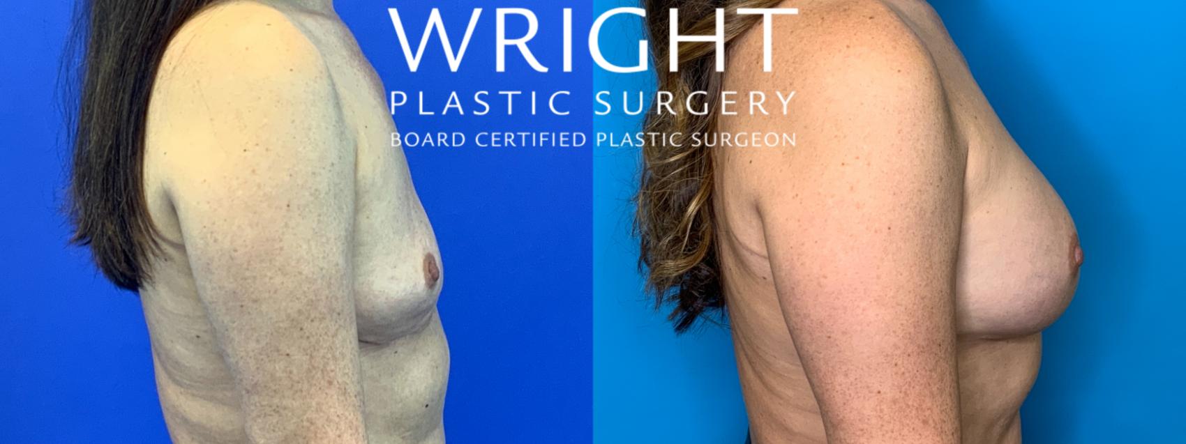 Before & After Breast Augmentation Case 234 Right Side View in Little Rock, Arkansas