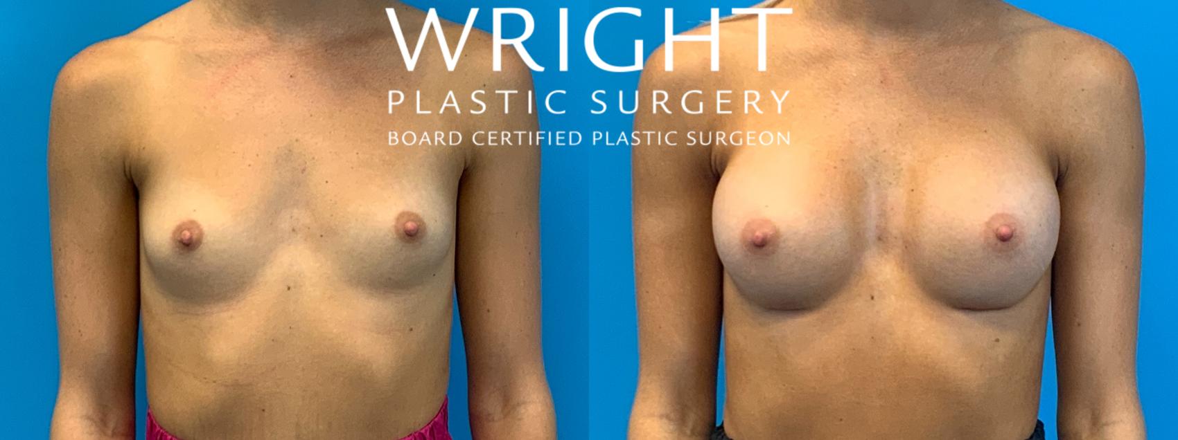 Before & After Breast Augmentation Case 237 Front View in Little Rock, Arkansas