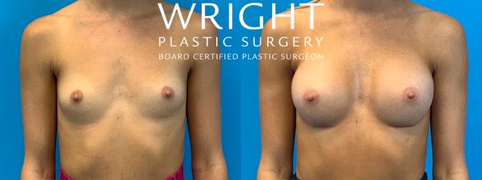 Before & After Breast Augmentation Case 237 Front View in Little Rock, Arkansas