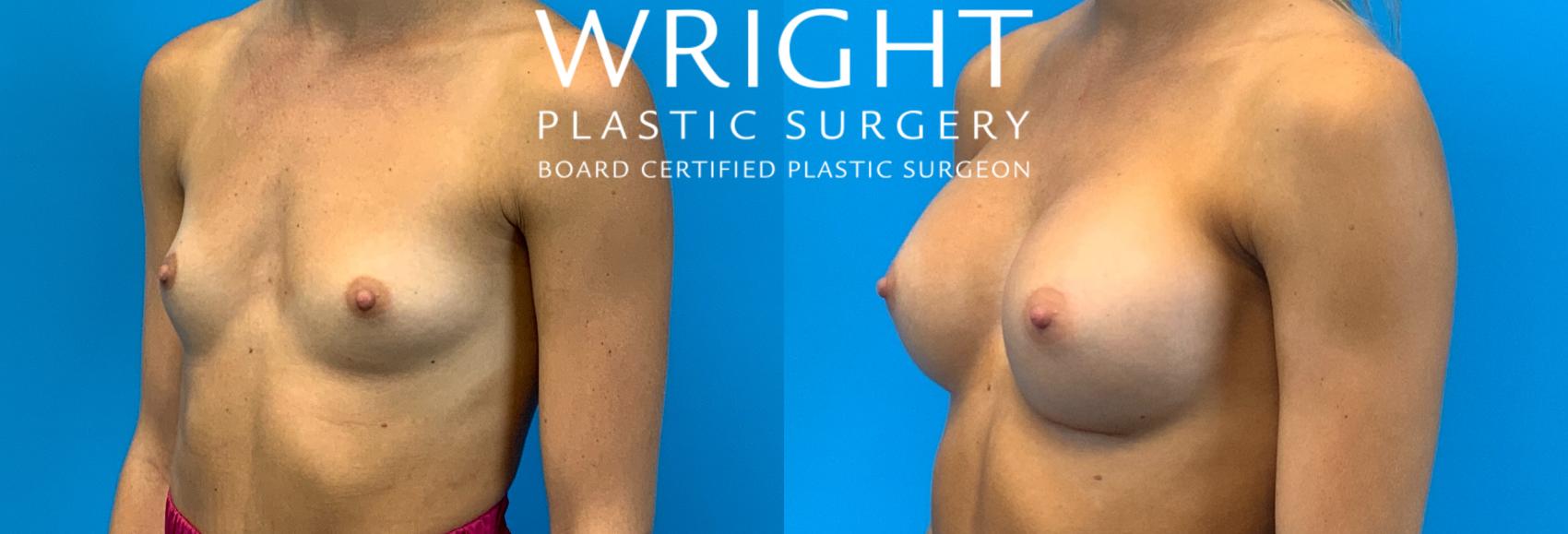 Before & After Breast Augmentation Case 237 Left Oblique View in Little Rock, Arkansas